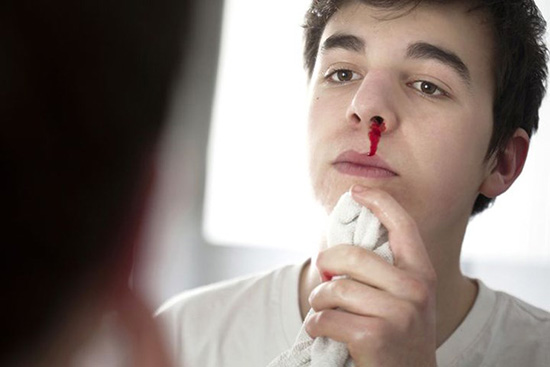 Xử lý chảy máu mũi như thế nào là đúng?